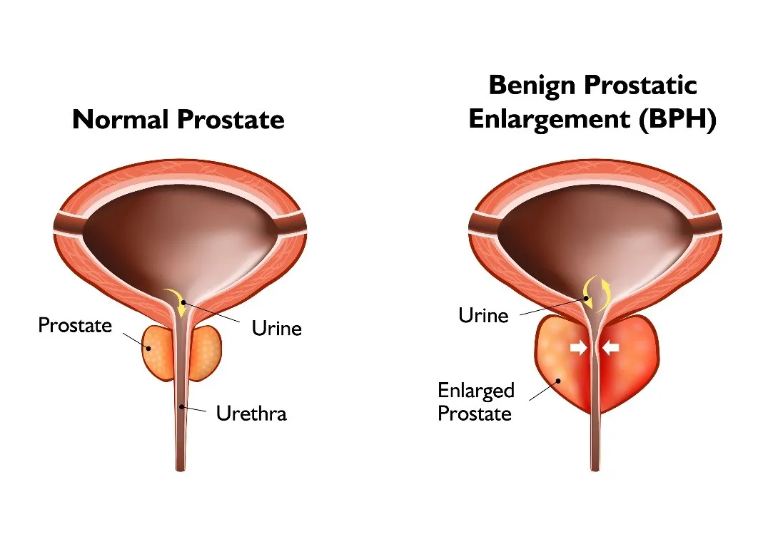 Diagram showing normal prostate vs enlarged prostate (BPH) blocking the urethra