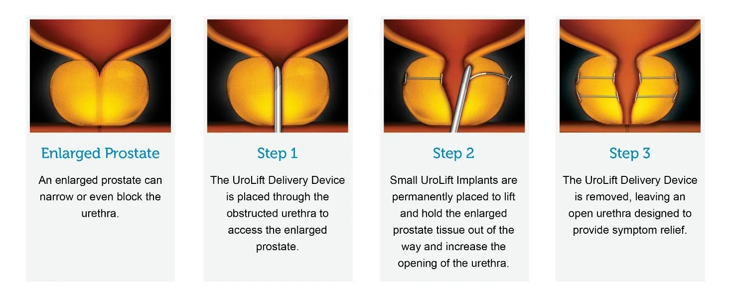 Step-by-step illustration of UroLift procedure opening the urethra by lifting enlarged prostate tissue