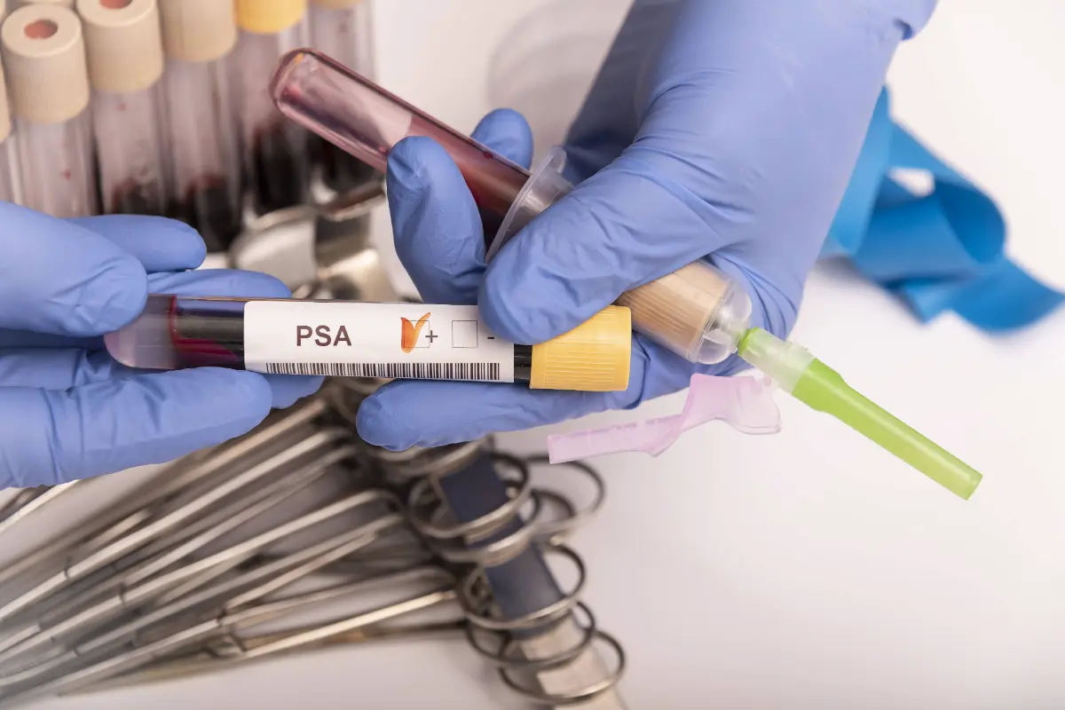 Close-up of blood collection tools and a vial labeled “PSA,” representing prostate cancer screening and early detection at Gregory Rhodes MD Cancer Center.