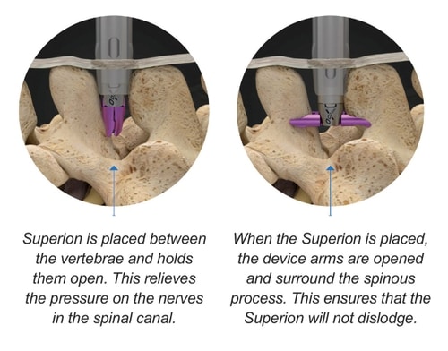 Superion Spinal Spacer