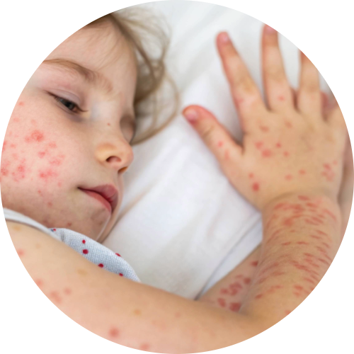 Young child with a fever and spots due to chickenpox.