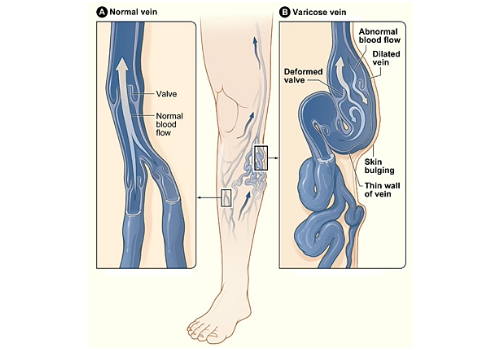 The illustration shows how a varicose vein forms in a leg. Figure A shows a normal vein with a working valve and normal blood flow. Figure B shows a varicose vein with a deformed valve, abnormal blood flow, and thin, stretched walls. The middle image shows