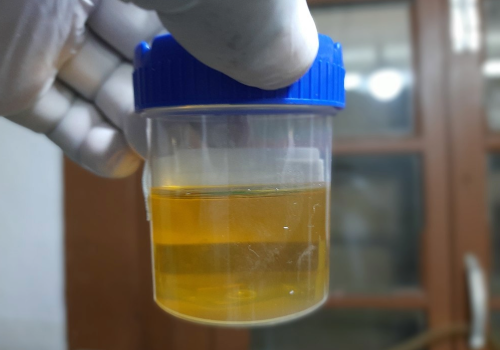 Does Yellow Pee Mean You’re Dehydrated? Here’s What Your Urine Color Really Says