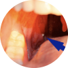 Close-up of a tonsil with a visible white tonsil stone emerging from a tonsil crypt