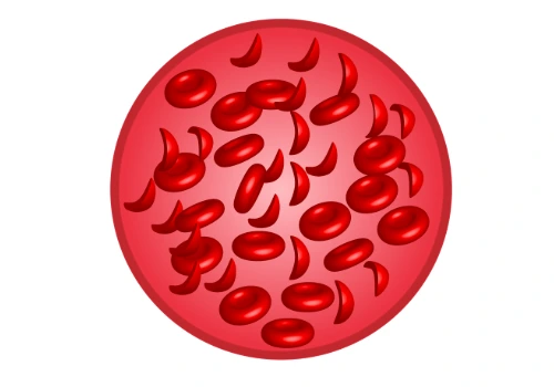 The Genetics of Sickle Cell Disease: Why It Affects Some Communities More