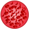 Illustration of sickle-shaped blood cells.