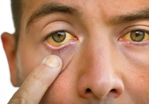 Jaundice: What It Means When Your Eyes or Skin Look Yellow
