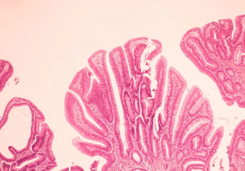 Collagen Types Linked to Breast Cancer Progression