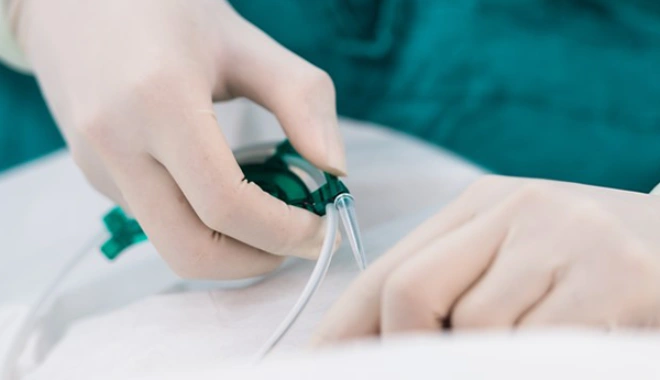 A vascular surgeon inserting a catheter into a patient's vein to treat it for varicose vein disease.