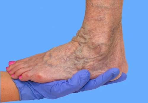 Person’s lower legs showing visible varicose veins, illustrating common vein changes associated with venous disease.