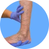 Person’s lower legs showing visible varicose veins, illustrating common vein changes associated with venous disease.