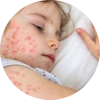 Child with measles rash resting in bed.