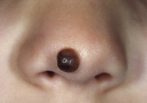 A dark, bulging mole on a person's nose.