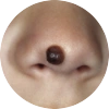 A dark, bulging mole on a person's nose.