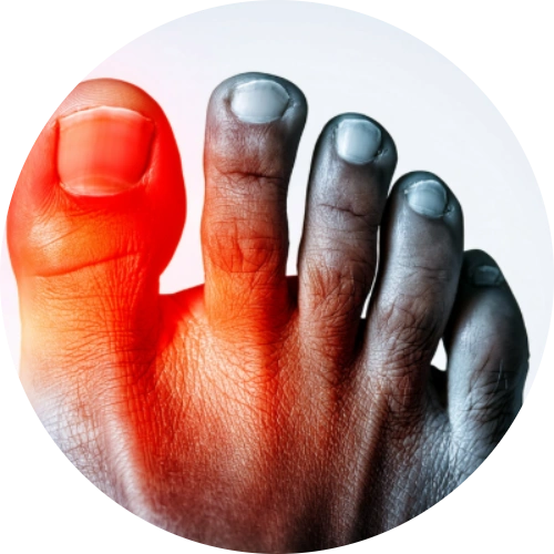 Bare foot with a visible bunion, highlighted red to signify pain.