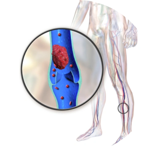 Medical diagram of Deep Vein Thrombosis