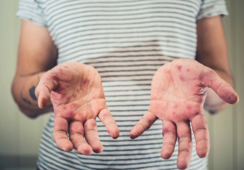 Teenager with visible blisters from hand foot and mouth disease