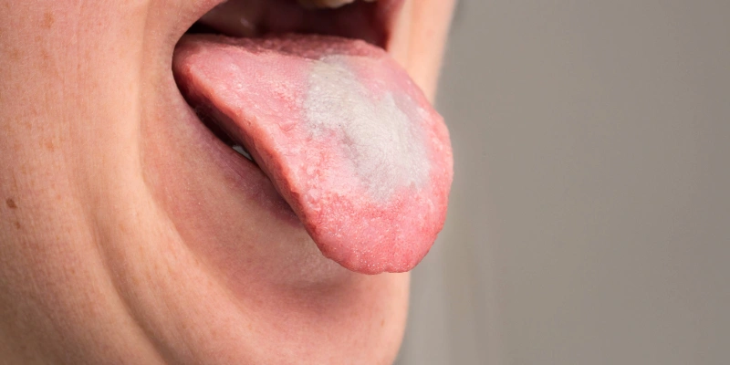 Woman's tongue infected with oral thrush
