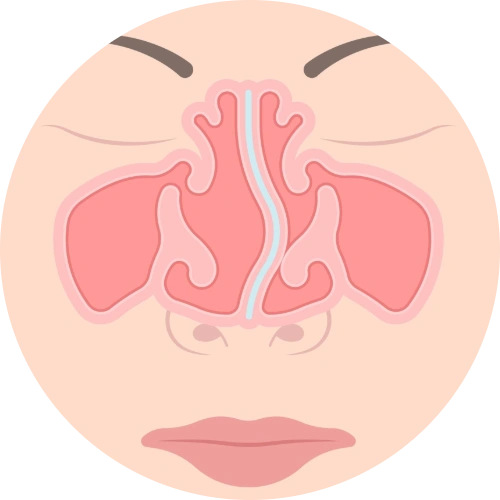 Diagram showing deviated septum affecting airflow