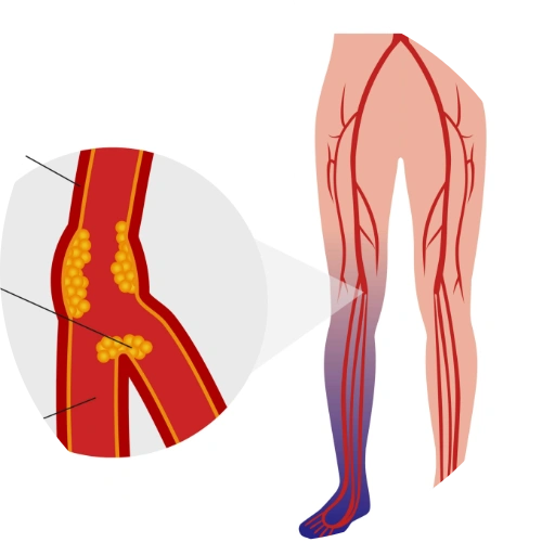 Medical diagram of Peripheral Arterial Disease