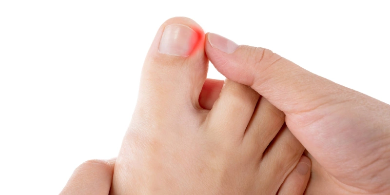 Ingrown toenail with redness and swelling along nail edge