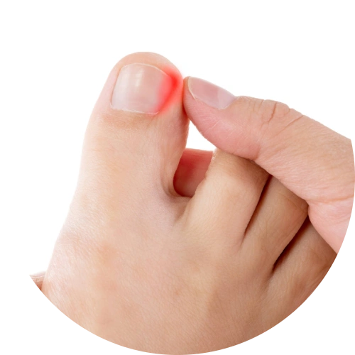 Ingrown toenail with redness and swelling along nail edge