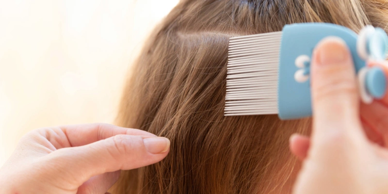 Close-up of hair showing nits attached near the scalp consistent with head lice