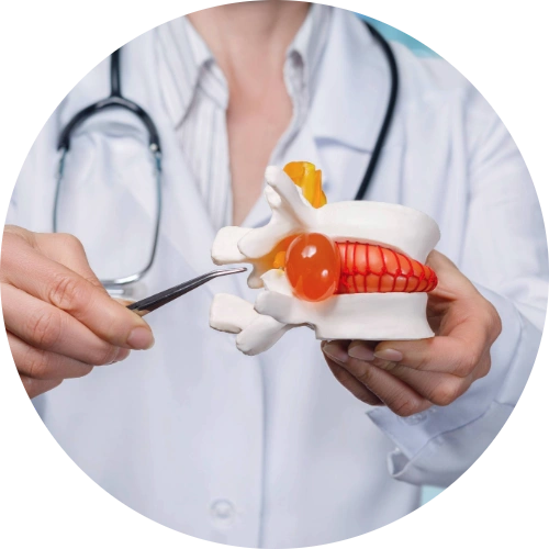A doctor pointing at herniated disc model with tweezers