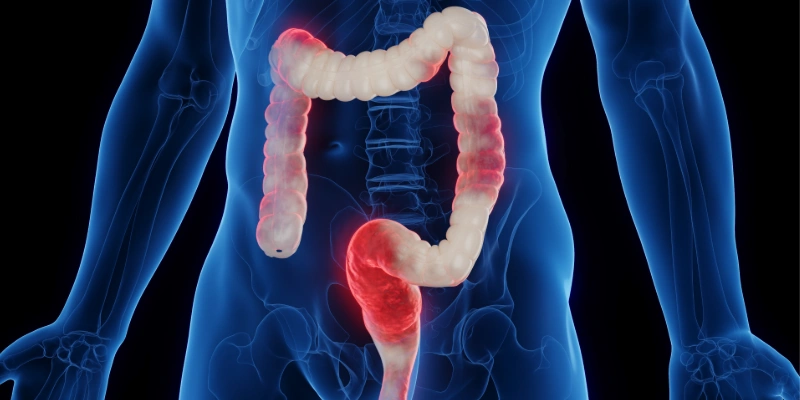 Illustration of inflamed colon consistent with ulcerative colitis