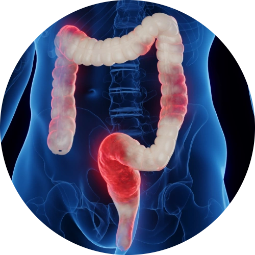Illustration of inflamed colon consistent with ulcerative colitis