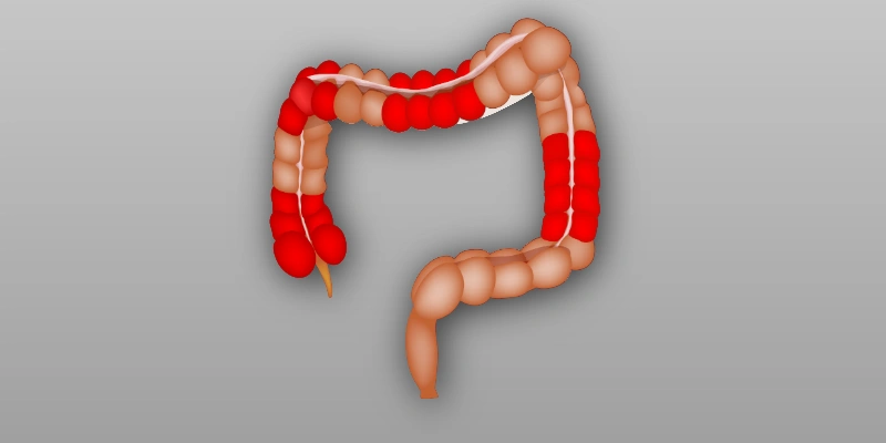 Diagram showing inflammation in the digestive tract associated with Crohn’s disease