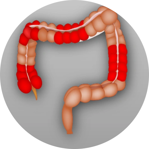 Diagram showing inflammation in the digestive tract associated with Crohn’s disease