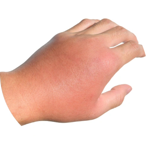 Inflamed, red, and swollen hand showing signs of cellulitis