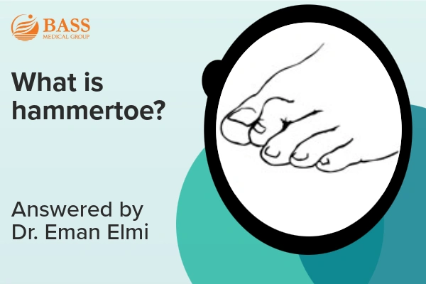 Video thumbnail with text "What is hammertoe?" and a diagram of toes with hammertoe