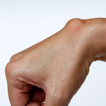A ganglion cyst on a wrist