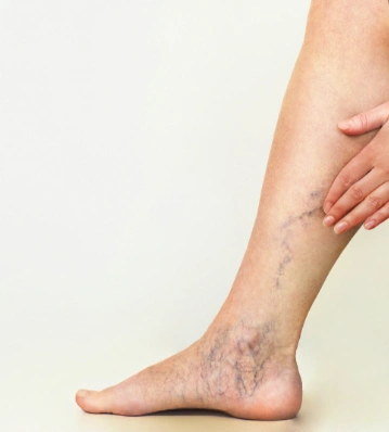 Bulging varicose vein on lower leg