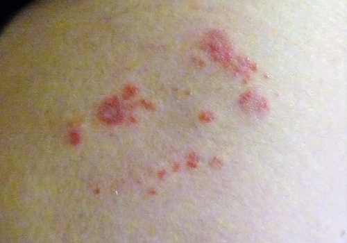 Red marks on skin resembling shingles