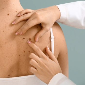 Doctor examining benign moles on a patient's back