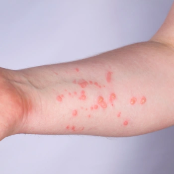 Red pock mark rash on a forearm