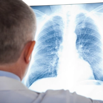 Doctor examining an x-ray of the lungs