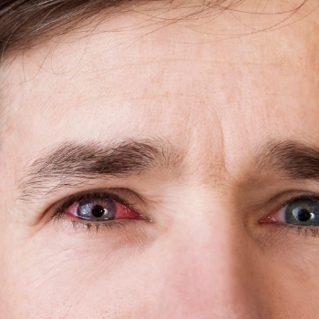 Man squinting with one red, inflamed eye
