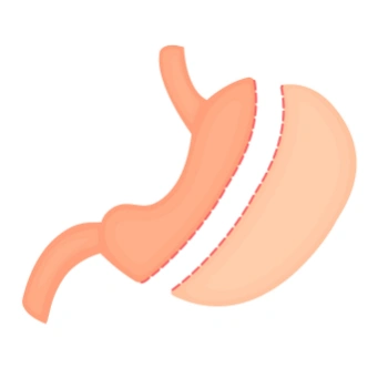 Cartoon diagram of gastric sleeve surgery