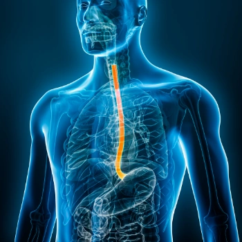 3D diagram of Barrett's esophagus