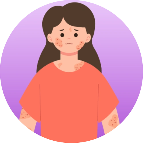 Illustration of a woman with a facial and body rashes, a common symptom associated with lupus