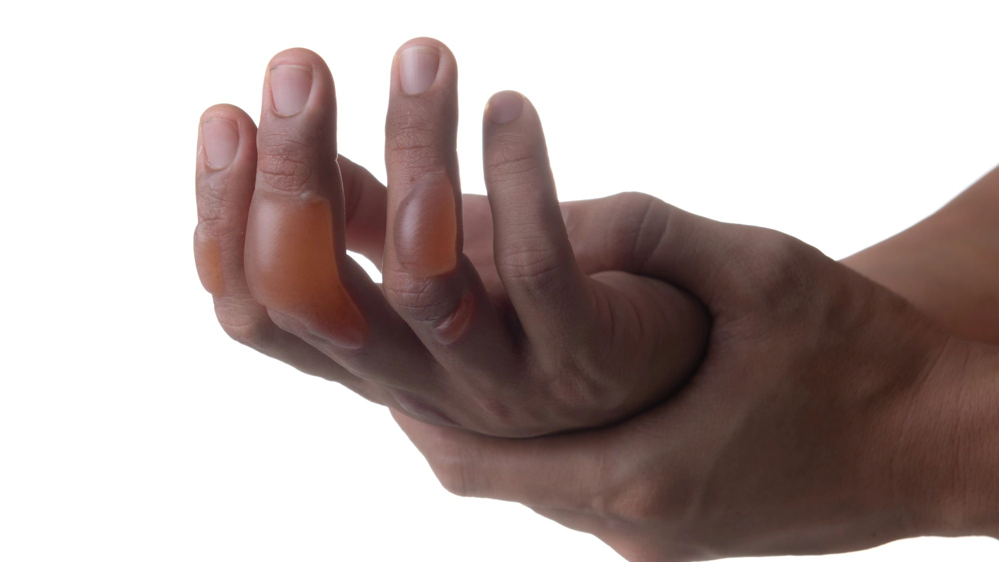 burn blister on the hand filled with clear fluid
