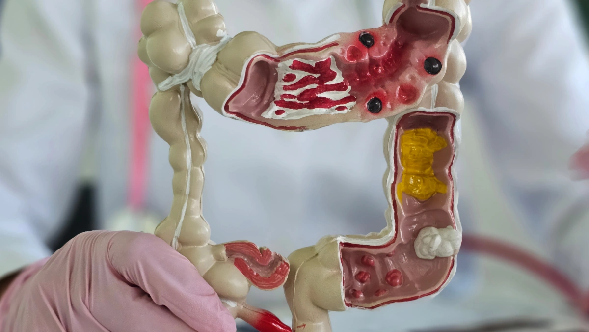 Doctor holding a 3D colon model while explaining colon cancer screening guidelines and the importance of preventive screening.