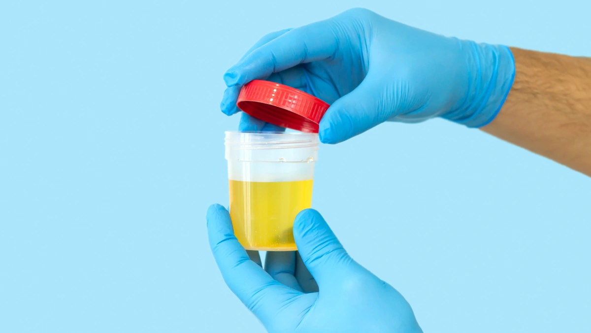 Nurse opening urine sample container for medical urinalysis