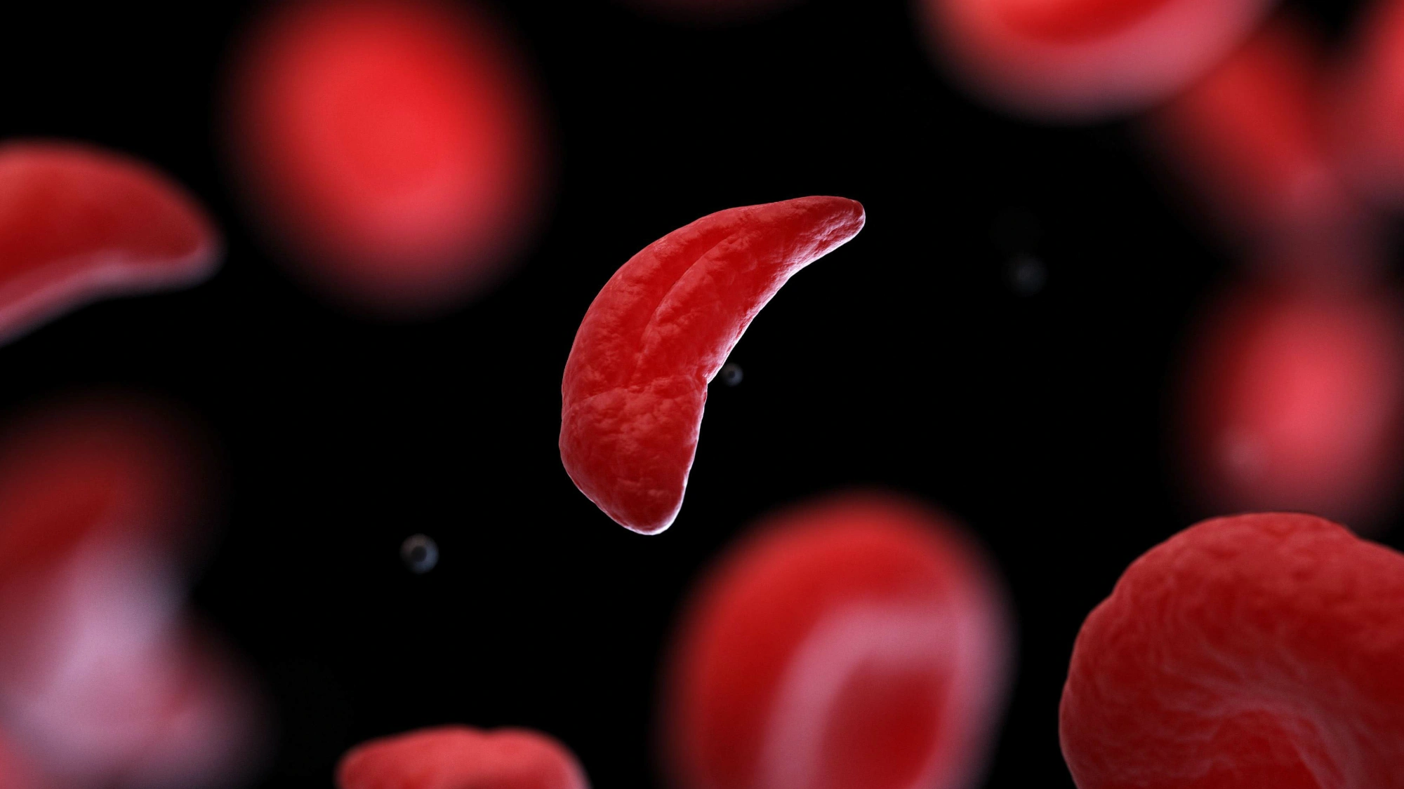 A sickle cell surrounded by normal blood cells