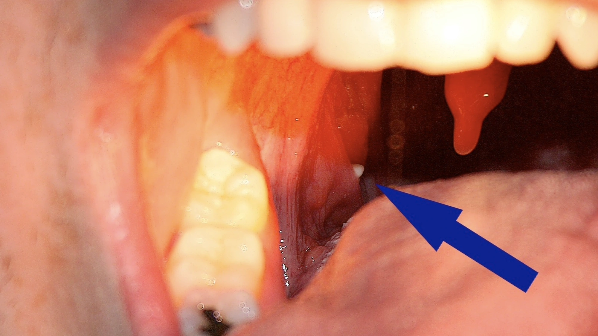 A tonsil with a visible white tonsil stone emerging