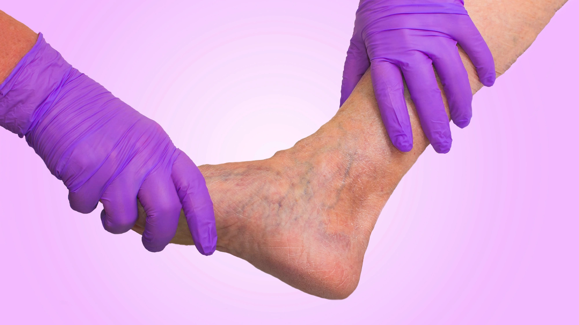 Lower limb vascular examination because suspect of venous insufficiency